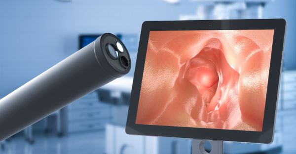 Qué es una colonoscopia y para qué sirve