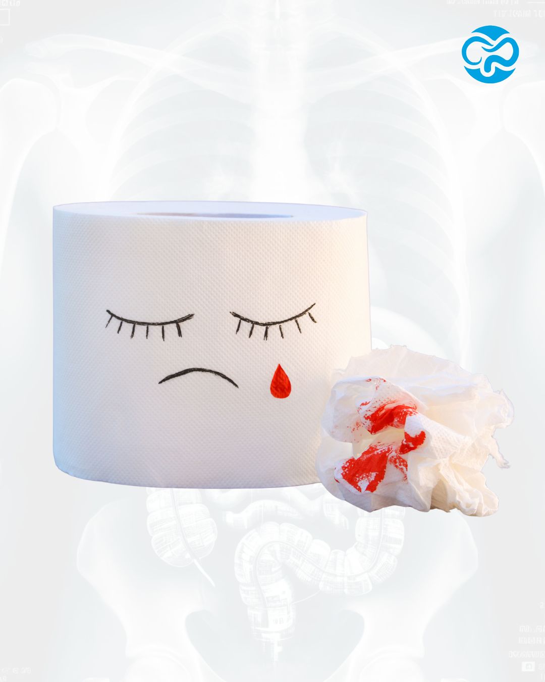 Señales de alarma de dolor y sangrado al evacuar que requieren coloproctólogo en Tijuana.