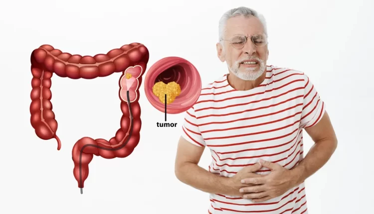 cáncer colorrectal